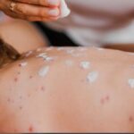 México Reporta 2,400 Casos de Sarampión; Ocupa el Segundo Lugar en las Américas