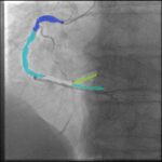 Doctorando de la UAS desarrolla método experimental a partir de imágenes de angiogramas para prevenir enfermedades cardiacas graves