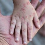 Llaman a la población a no alarmarse con el aumento de casos de coxsackie, ya que en la mayoría de los pacientes no tiene repercusiones graves