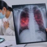 La tuberculosis es curable si se detecta y trata oportunamente